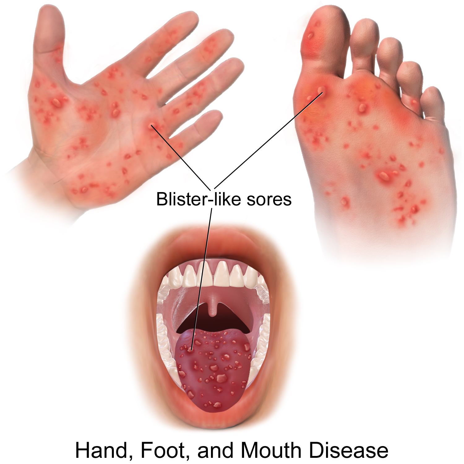 Hand foot & mouth disease